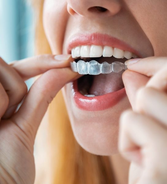 Patient placing an Invisalign tray