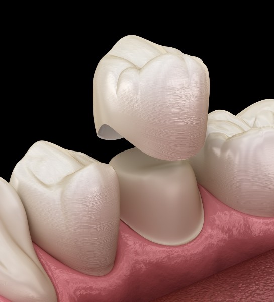 Animated smile during dental crown restorative dentistry treatment