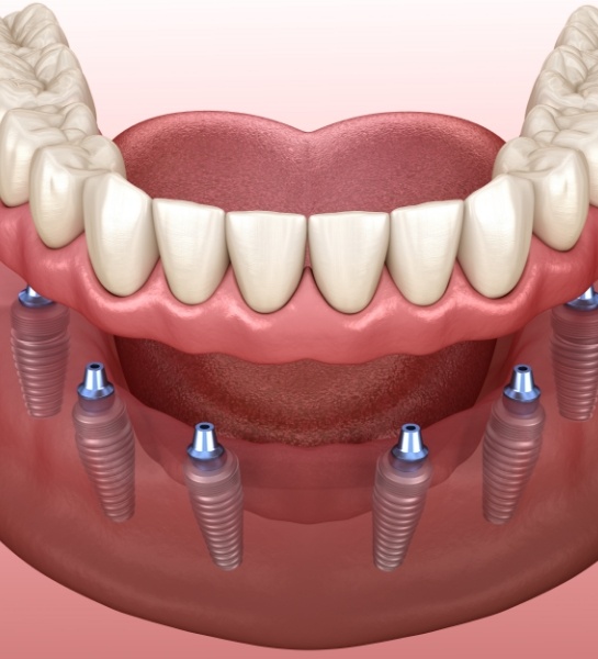 Animated smile during full mouth reconstruction