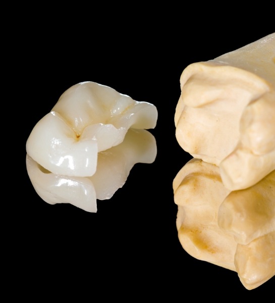 Model of a tooth with metal free dental restoration