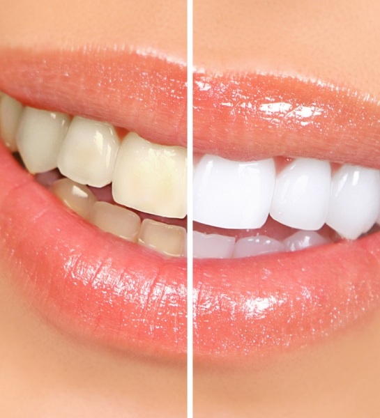 Closeup of smile before and after teeth whitening