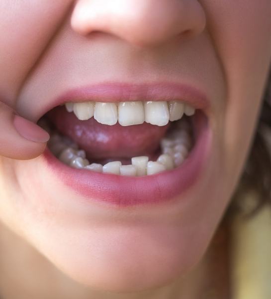 Dental patient with crowded teeth before Invisalign treatment