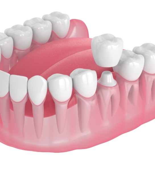 Animated smile during dental crown placement