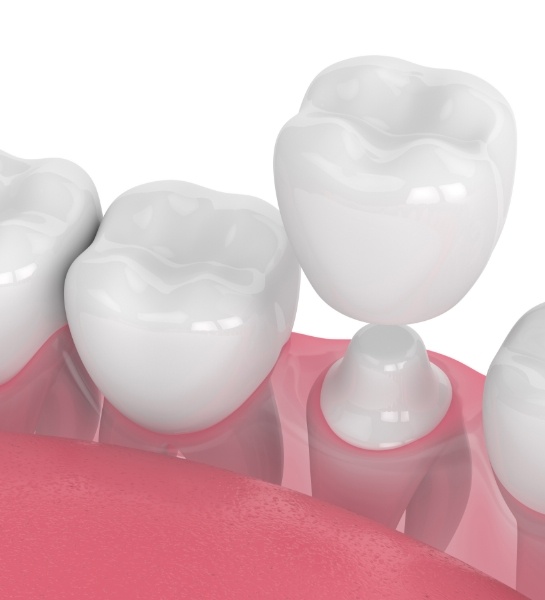Closeup of animated smile during dental crown placement