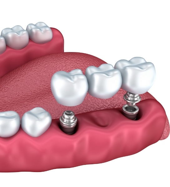 Animated smile during dental bridge placement