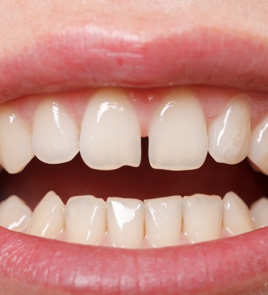 Closeup of smile with gaps between teeth