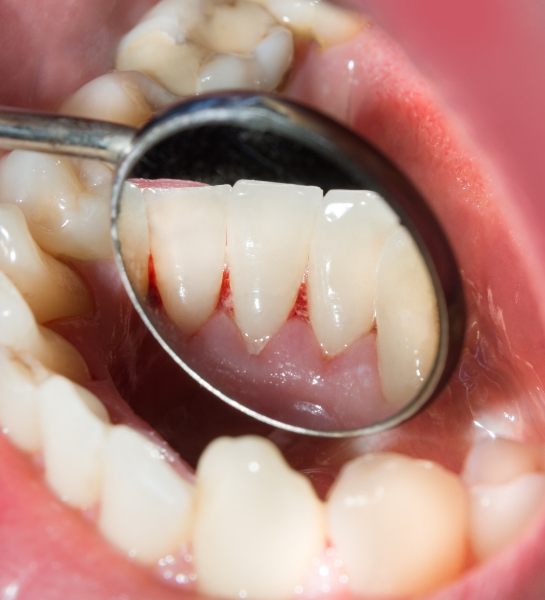 Closeup of smile with damaged gumes before gum disease treatment