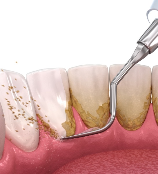 Animated smile during scaling and root planing treatment