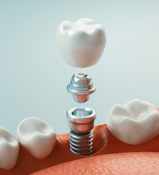 How Dental implants work in Naples