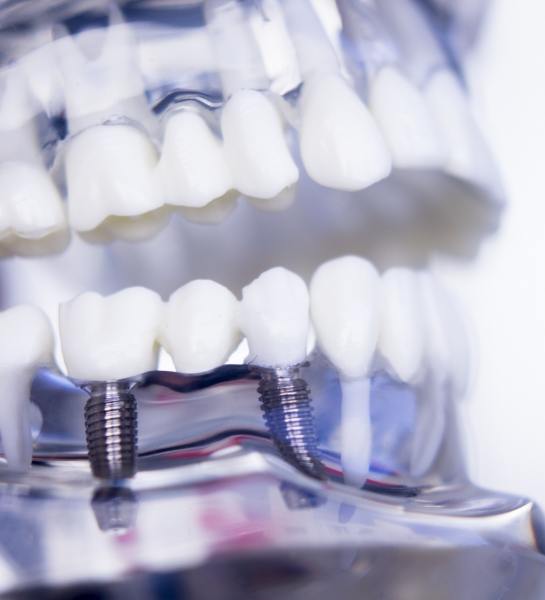 Model smile with dental implant supported fixed bridge