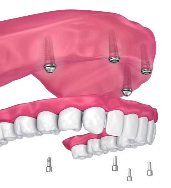 Animated smile during dental implant supported denture placement