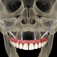 3 D image of jaw and skull with dental implant supported dentures