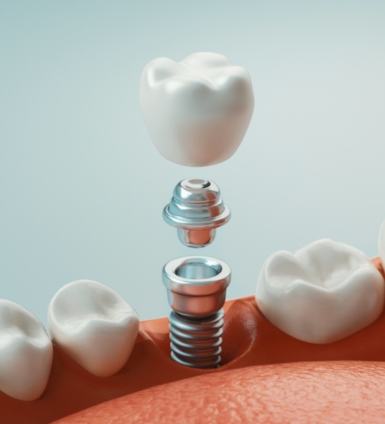 Animated dental implant supported dental crown placement process