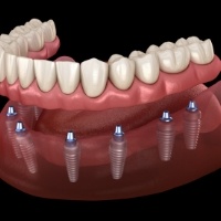 Animated smile during dental implant supported denture placement