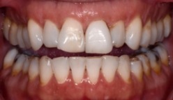 Closeup of damaged smile before cosmetic dentistry