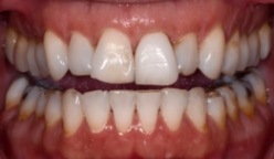 Close up of flawed teeth of Naples dental patient