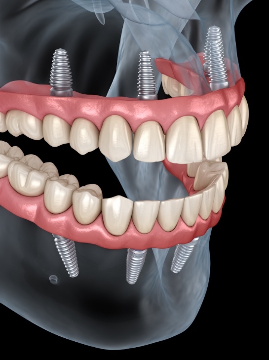 Model of a mouth with full implant dentures