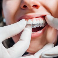 Dentist placing Invisalign aligner on patient's teeth