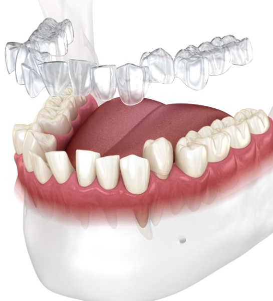Smile fitted for Invisalign tray