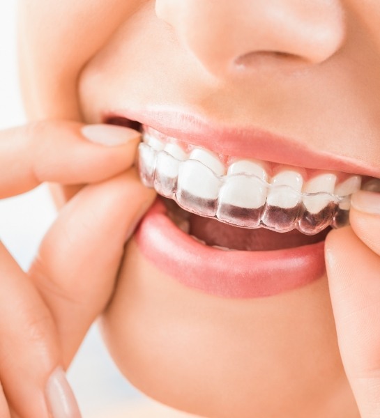 Dental patient placing an Invisalign tray