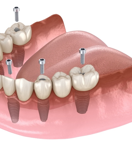 Animated smile during dental implant supported denture placement