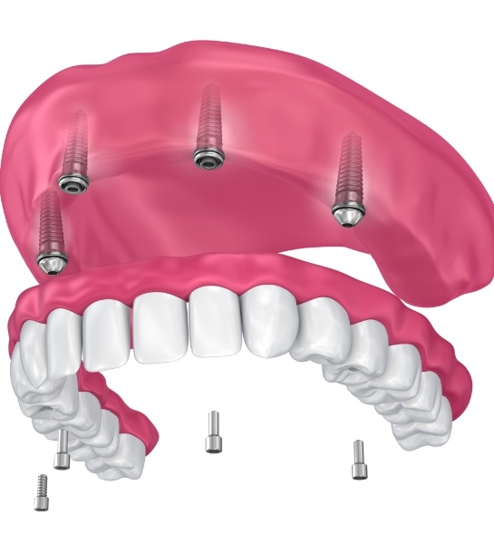 Animated smile during dental implant supported denture placement