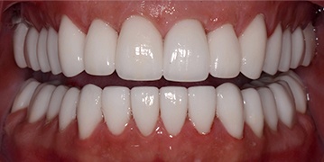 Flawless healthy smile after cosmetic dentistry