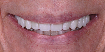 Bright white smile after teeth whitening