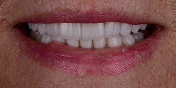 Bright smile after cosmetic dentistry