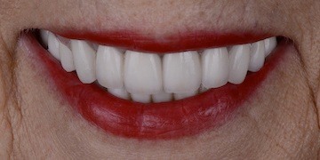 Healthy beautiful smile after cosmetic dentistry