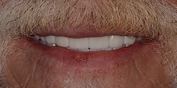 Flawless healthy smile after cosmetic dentistry