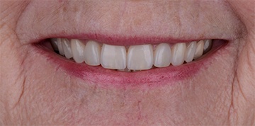 Bright white and perfectly aligned teeth after cosmetic dental care