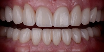 Healthy evenly sized smile after cosmetic dentistry