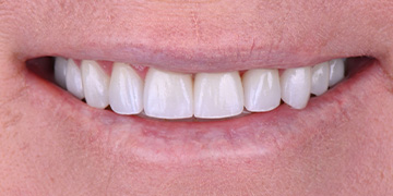 Healthy evenly sized teeth after cosmetic dentistry