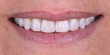 Bright smile after teeth whitening