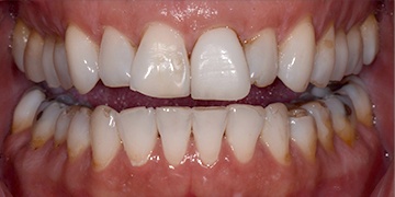 Damaged and misaligned teeth before cosmetic dentistry
