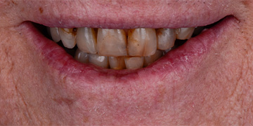 Severely discolored decayed teeth before cosmeitc dentistry