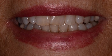Yellowed teeth before cosmetic dentistry