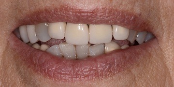 Discolored and damaged smile before cosmetic dentistry