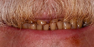Yellowed and damaged teeth before cosmetic dentistry