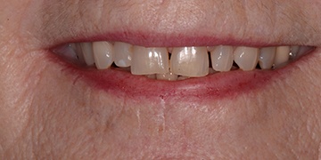 Dark yellow and misaligned teeth before cosmetic dental care