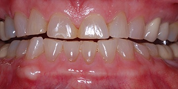Short worn teeth before cosemtic dentistry