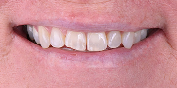 Worn and uneven teeth before cosmetic dentistry