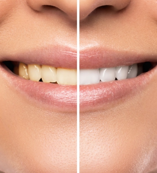 Smile before and after teeth whitening