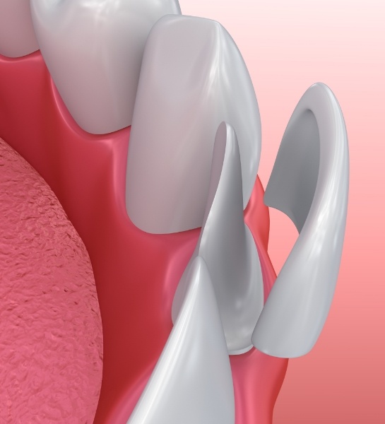 Animated smile showing porcelain veneer placement