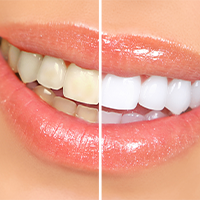 Dental patient receiving in office teeth whitening treatment