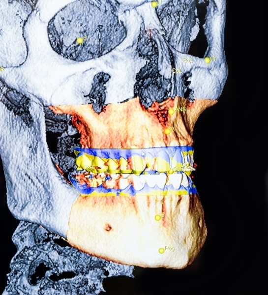 3 D digital x-ray scans