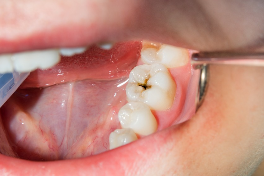 What Happens If You Don't Treat a Cavity? A Dentist Explains