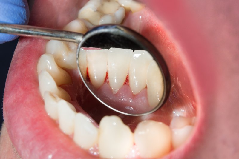 dentist doing an oral cancer screening in Naples