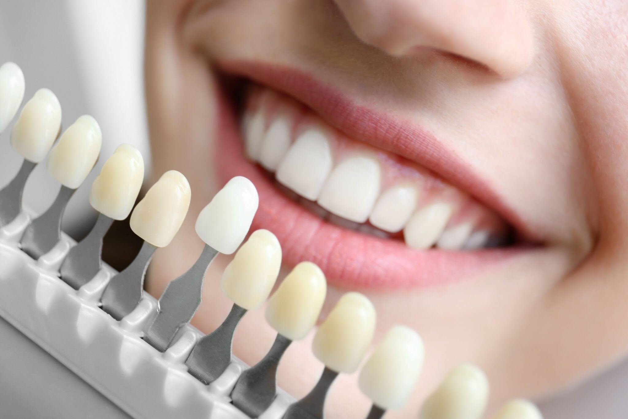 Dental Discoloration Can Bonding Be Whitened? Dr. Jeffrey Skupny
